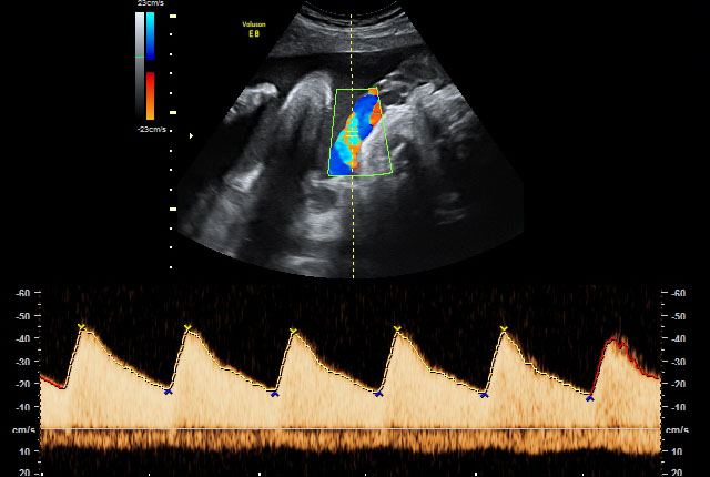 Doppler-Ultraschall/-Sonografie Doppler Arteria umbilikalis 34. SSW