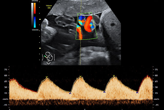 Doppler-Ultraschall/-Sonografie Doppler Arteria umbilikalis 34. SSW