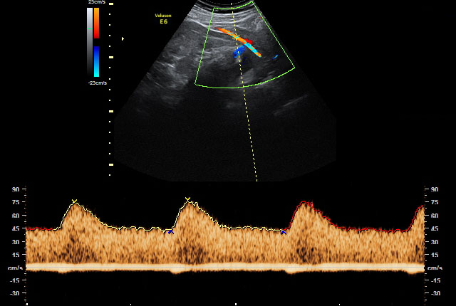 Doppler-Ultraschall/-Sonografie Doppler Arteria uterina 35. SSW