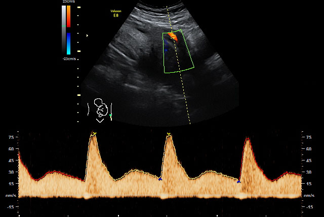 Doppler-Ultraschall/-Sonografie Doppler Arteria uterina 28. SSW