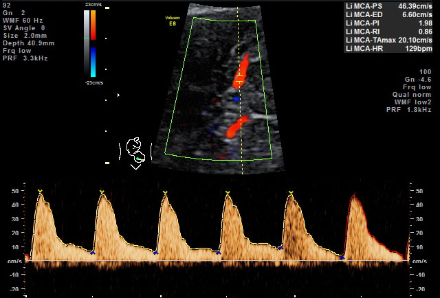 Doppler-Ultraschall/-Sonografie – Frauenärztin Dr. med. Andrea Baumann ...