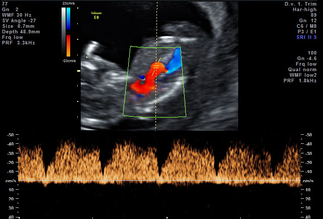 Doppler-Ultraschall/-Sonografie – Frauenärztin Dr. med. Andrea Baumann ...